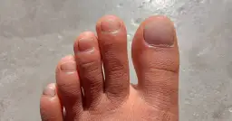 Duży palec u stopy - objawy, przyczyny i skuteczne leczenie