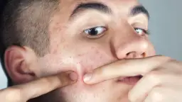 Zbliżenie na twarz młodego mężczyzny z zaczerwienioną skórą i pryszczami, palce naciskają na wyprysk.