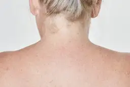 Trądzik na plecach? Poznaj przyczyny i odzyskaj gładką skórę!