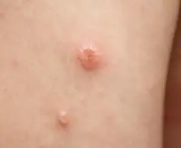 Guzek w pachwinie do jakiego lekarza? Poznaj ważne informacje zdrowotne