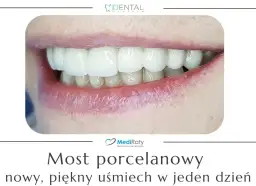 Mostek na zębach: Zobacz, jak wygląda i odzyskaj uśmiech!