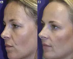 Nieudany botoks? Przyspiesz zanikanie i koryguj efekty