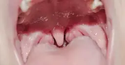 Jakie badania przed wycięciem migdałków? Kluczowe informacje i porady