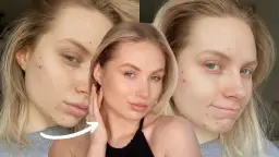 Jak ukryć pryszcza w domu? Szybkie domowe sposoby krok po kroku