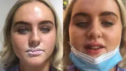 Alkohol po kwasie hialuronowym? Dlaczego to błąd i co tracisz?