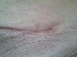 Zbliżenie na gojący się strupek na skórze z widocznymi porami i włoskami.