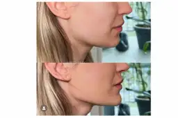 Endermologia twarzy: Lifting bez skalpela? Sprawdź efekty!