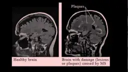 Filmy o stwardnieniu rozsianym: jak zrozumieć chorobę i jej wpływ na życie