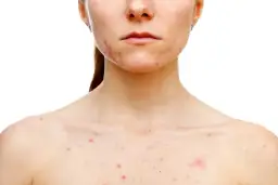 Skuteczne sposoby na pryszcze – co zrobić z pryszczami, aby zniknęły