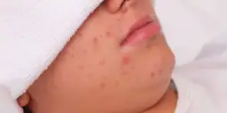 Pryszcze podskórne: Koniec z bólem! Skuteczne leczenie i profilaktyka