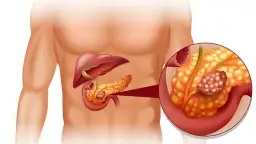 Trzustka: Jakie badania wykonać, by szybko postawić diagnozę?