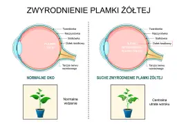 Zwyrodnienie plamki żółtej: objawy, które musisz znać, zanim będzie za późno