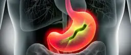 Objawy H. pylori w jamie ustnej: co mówi Twój oddech i język?