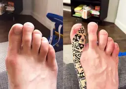 Co robić, gdy boli haluks? Domowe i profesjonalne sposoby