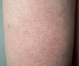 Jak pozbyć się czarnych kropek po goleniu - skuteczne metody i porady