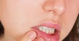 Co to jest afta w jamie ustnej i jak uniknąć bólu i dyskomfortu