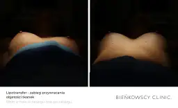 Trwałość lipofillingu biustu: Ile tłuszczu zostanie z Tobą na lata?