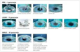 Laserowa korekcja wzroku - jak bezpieczny jest zabieg i jakie daje efekty