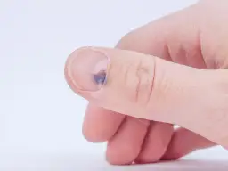 Co oznacza jeden czarny paznokieć? Przyczyny i leczenie