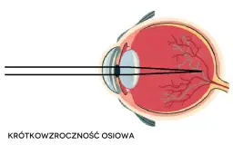 Czy wada wzroku minus może się cofnąć: Prawda o leczeniu krótkowzroczności