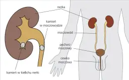Jakie są przyczyny kamicy nerkowej? Poznaj czynniki ryzyka i zapobieganie