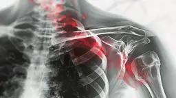 Złamanie obojczyka: 5 objawów których absolutnie nie lekceważ
