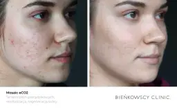 Skuteczne leczenie cery trądzikowej - sprawdzone metody i produkty