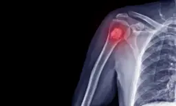 Najczęstsze objawy raka kości - co powinno Cię zaniepokoić i kiedy do lekarza