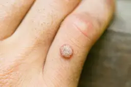 Skąd się biorą kurzajki? Oto przyczyny, objawy i sposoby zapobiegania