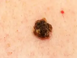 Brodawka łojotokowa - czy może odpaść? Fakty i mity