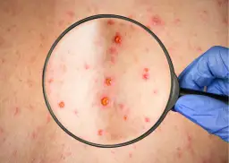 Pierwsze objawy ospy wietrznej: rozpoznaj chorobę na wczesnym etapie