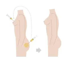 Lipofilling biustu – czy warto? Opinie i doświadczenia kobiet.