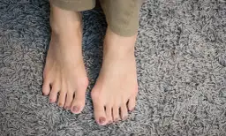 Jak leczyć haluksy skutecznie? Sprawdzone metody i porady