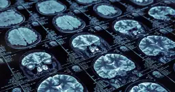 Jak zapobiec Alzheimerowi: skuteczne metody ochrony zdrowia mózgu