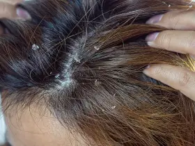 Widoczne białe płatki na ciemnych włosach. Czy to łupież? Dowiedz się, dandruff co to jest i jak sobie z nim radzić.