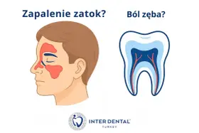 Zapalenie zatok czy ból zęba? Nawet delikatny dotyk językiem może wywołać ostry ból zęba, gdy problem dotyczy nerwów.