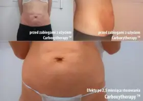 Karboksyterapia efekty: brzuch przed i po 2,5 miesiąca terapii. Widoczna poprawa napięcia skóry i redukcja rozstępów.
