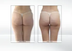 Endermologia: Ile cm stracisz? Realne efekty i wskazówki