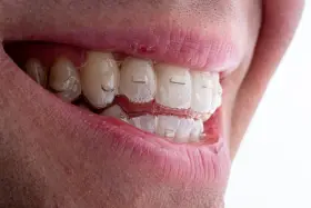 Uśmiech z przezroczystymi nakładkami Invisalign. Zastanawiasz się nad Invisalign cena? To inwestycja w prosty zgryz.