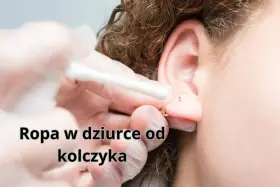Ropa w dziurce od kolczyka, widoczna podczas czyszczenia ucha wacikiem.