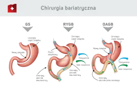 Ilustracja porównuje trzy typy operacji bariatrycznych: GS, RYGB, OAGB. Dowiedz się, ile kosztuje operacja bariatryczna i jakie są jej rodzaje.