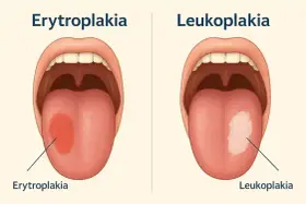 Objawy raka jamy ustnej: erytroplakia (czerwona plama) i leukoplakia (biała plama) na języku.