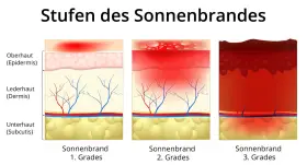 Illustrationen zeigen Hautschichten bei Sonnenbrand 1., 2. und 3. Grades. Der Sonnenbrand 2. Grades zeigt Blasenbildung in der Epidermis und Rötung der Dermis.