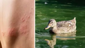 Haut mit roten Pusteln, die auf einen Zerkarien Ausschlag hindeuten, neben einer Ente im Wasser.
