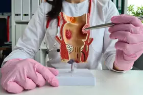 Model jelita grubego z widocznymi guzkami krwawniczymi. Lekarz w różowych rękawiczkach wyjaśnia, co to hemoroidy.