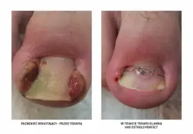 Przed i w trakcie terapii wrastającego paznokcia klamrą VHO Osthold Perfect. Tribiotic na wrastający paznokieć może pomóc w leczeniu.