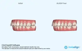 Porównanie zębów przed i po leczeniu nakładkami Invisalign. Widoczna poprawa zgryzu dzięki technologii ClinCheck.