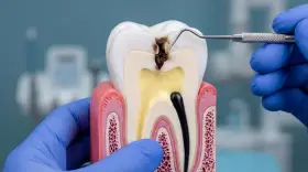 Model zęba pokazuje zaawansowaną próchnicę, która dotarła do miazgi. Dentysta w niebieskiej rękawiczce bada ubytek.