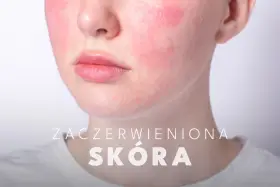 Widoczne zaczerwienienie na policzkach, które pokazuje, jak wygląda rumień. Skóra jest podrażniona i zaczerwieniona.