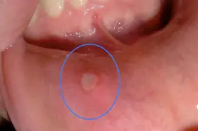 Una piccola afte, simile a bolle sulle labbra, circondata da un alone rosso, visibile all'interno della bocca.